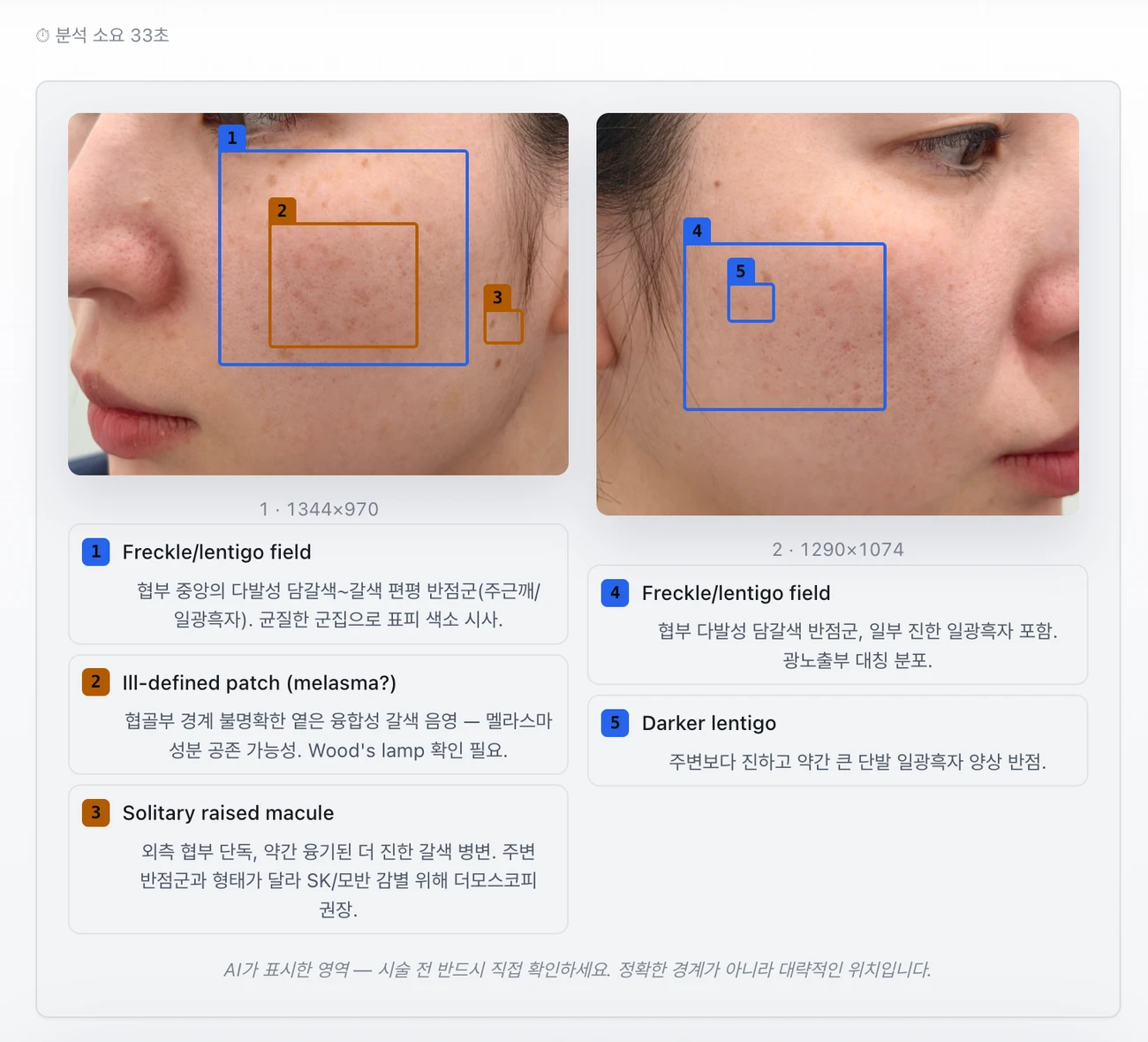 DermatoScan AI 병변 분석